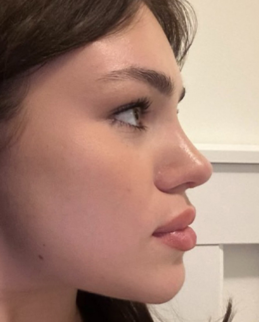 After rhinoplasty — Maria — Female, 24