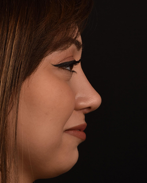 After rhinoplasty — Jules — Female, 23
