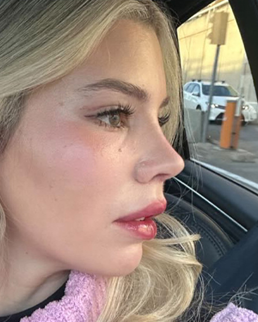 After rhinoplasty — Anne — Female, 21