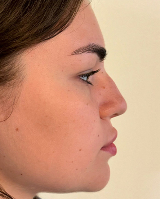 Before rhinoplasty — Maria — Female, 24