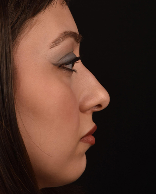 Before rhinoplasty — Jules — Female, 23