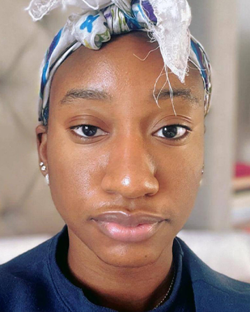 Before rhinoplasty — Jessica — Female, 26