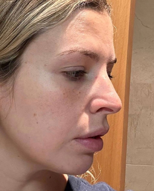 Before rhinoplasty — Anne — Female, 21